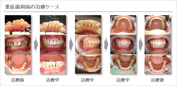 (草加市 歯科)重症歯周病の治療ケース