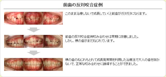 (草加市 歯科)前歯の反対咬合症例