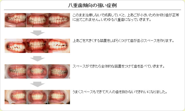 (草加市 歯科)八重歯傾向の強い症例