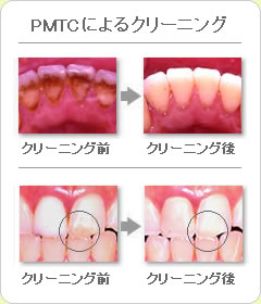 (草加市 歯科)PMTCによるクリーニング
